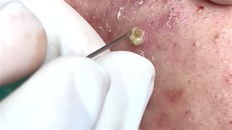 Some find extractions and the emptying of <strong>cysts</strong>. . Blackhead cystic acne removal videos